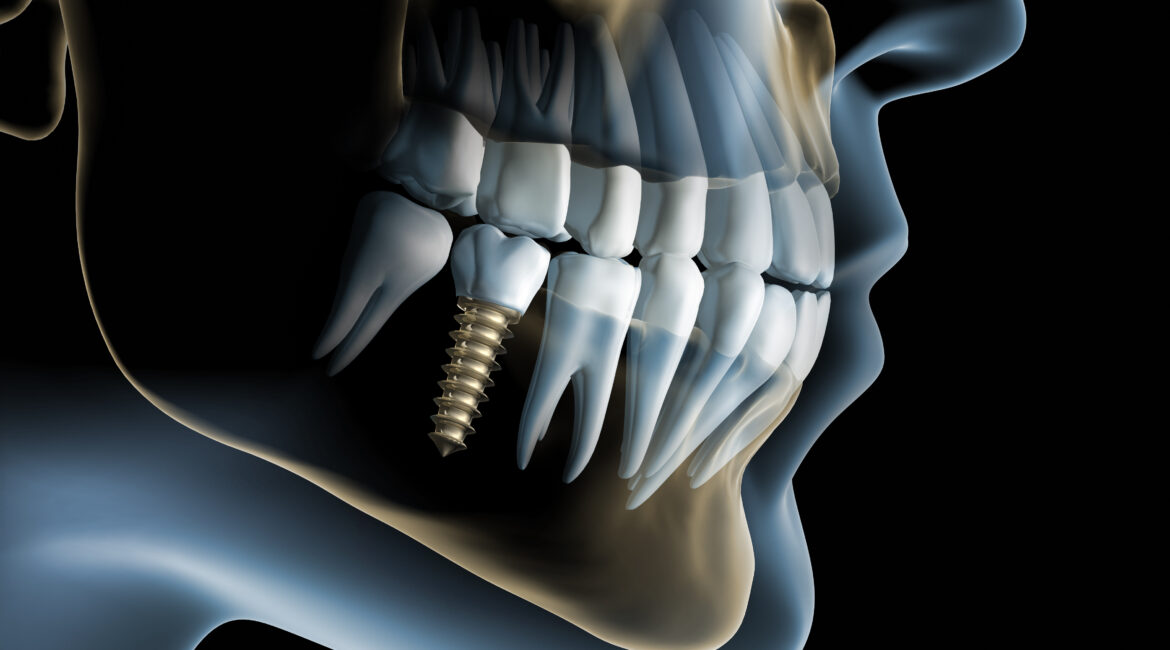 ebook implantes dentarios