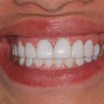 Facetas de resina: será a melhor opção?