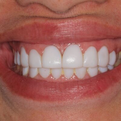 Facetas de resina: será a melhor opção?