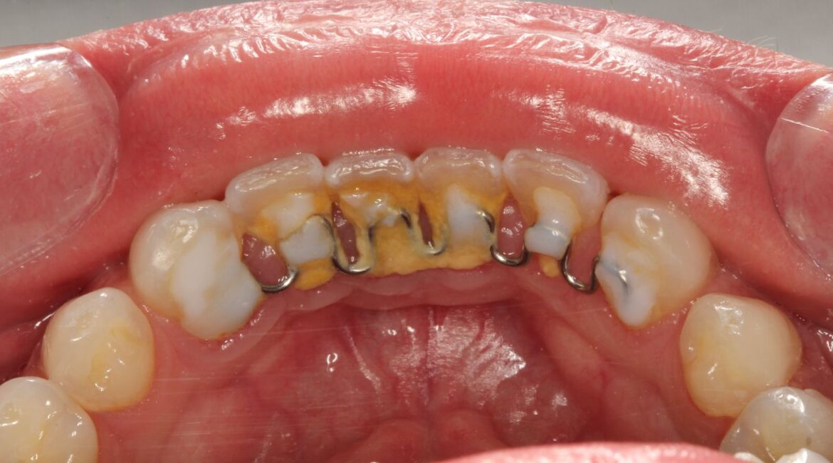 Contenções higiênicas