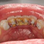 Contenções higiênicas: por que podem ser prejudiciais