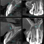 Você já ouviu falar em apicectomia?