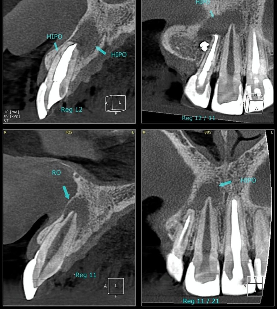 Você já ouviu falar em apicectomia?