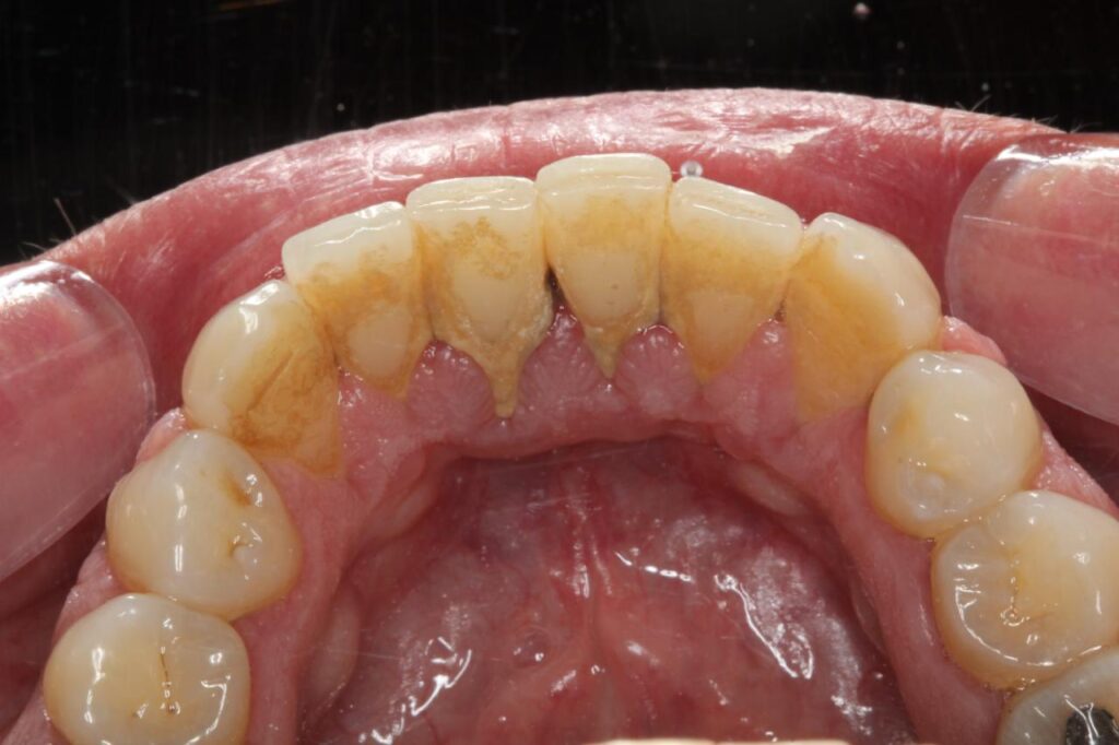 Profilaxia dentária: por que ela é essencial para a saúde da sua boca?