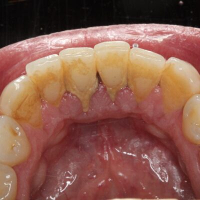 Profilaxia dentária: por que ela é essencial para a saúde da sua boca?